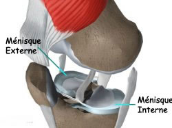 Menisque (traumatique ou dégénératif) - Groupe Chirurgical Thiers