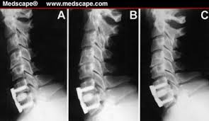 Arthrodèse cervical antérieure - Groupe Chirurgical Thiers