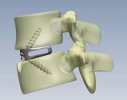 Arthrodèse lombaire antérieure - Groupe Chirurgical Thiers