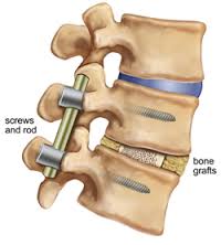 Arthrodèse lombaire postérieure - Groupe Chirurgical Thiers